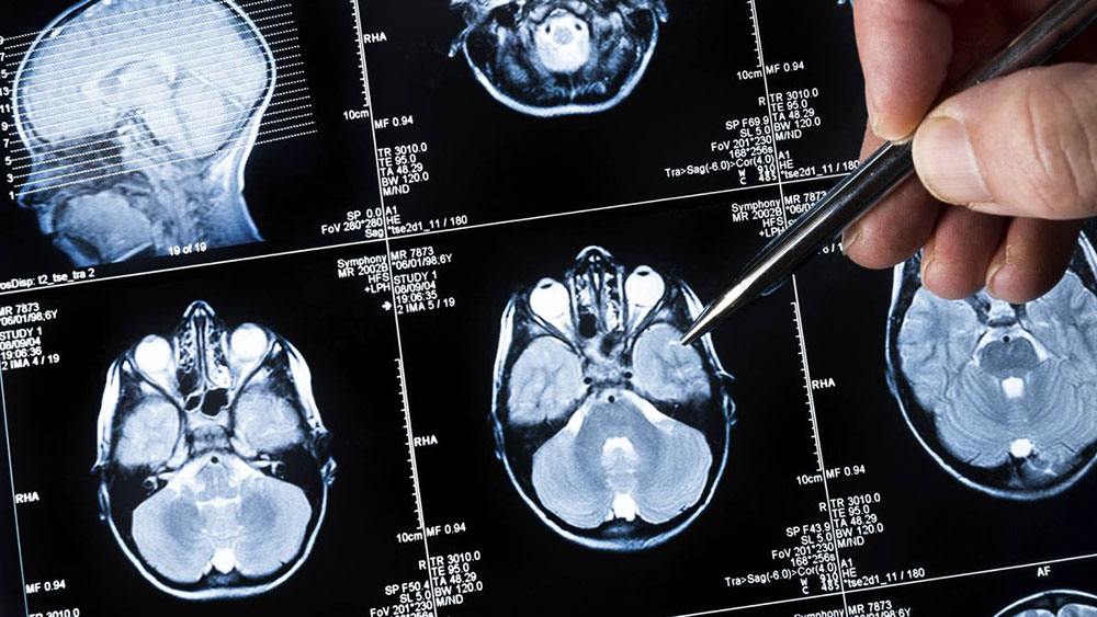 Cerebro y corazón: dos órganos vinculados con factores de riesgos compartidos