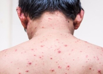 Brote de varicela en cuartel militar de Encarnación: “No hay circulación comunitaria del virus”