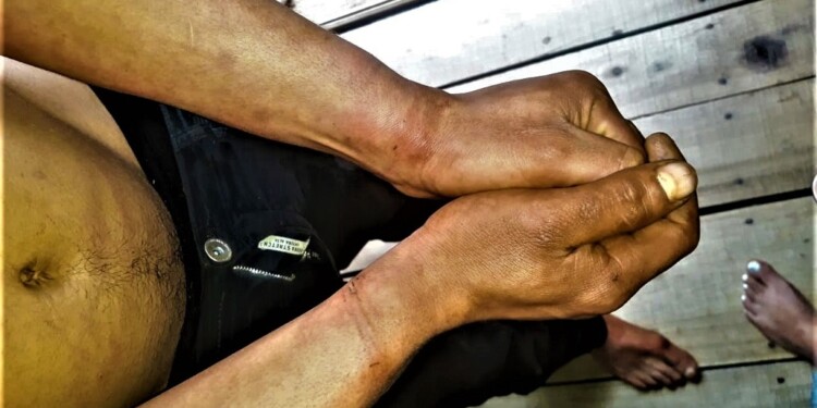 MARCAS. Las muñecas de la víctima y el rastro de las esposas policiales.