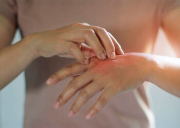 Psoriasis: a qué síntomas estar atentos para hacer una consulta