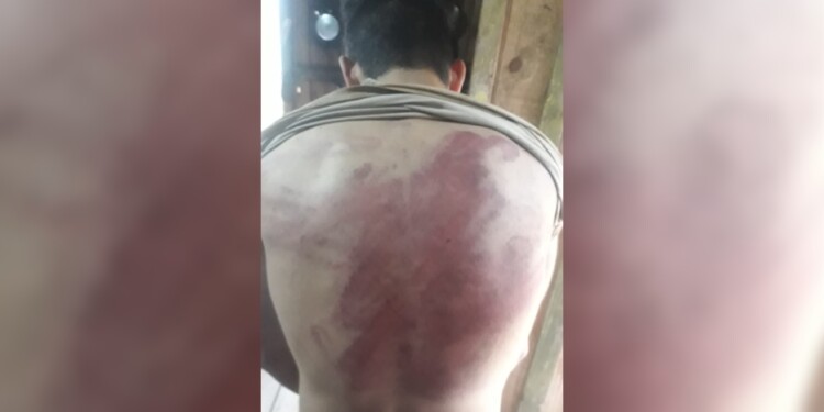 NO ES MAQUILLAJE. Así quedó la espalda del denunciante tras la golpiza.