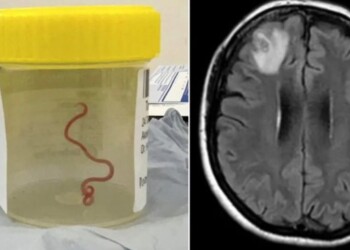 Descubren por primera vez en la historia un gusano parásito en el cerebro de una mujer