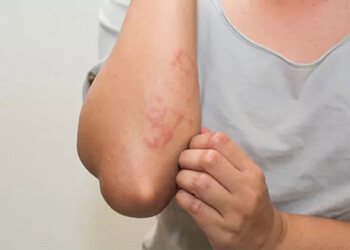 Dermatitis Atópica: sugerencias para tratar esta enfermedad crónica pero no contagiosa