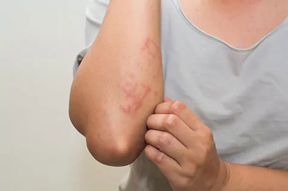 Dermatitis Atópica: sugerencias para tratar esta enfermedad crónica pero no contagiosa