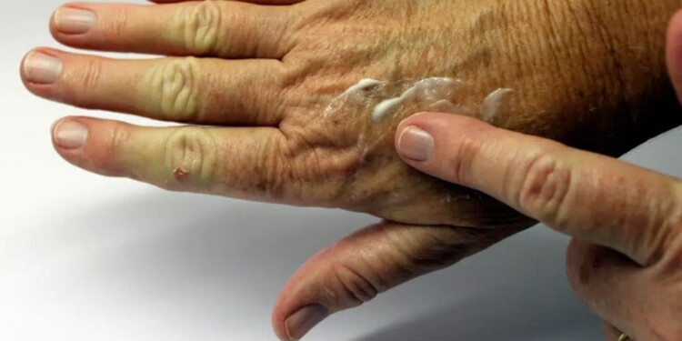 PREVENIR. Algunas afecciones en la piel pueden tratarse de detectarse a tiempo y no terminan en un cáncer.