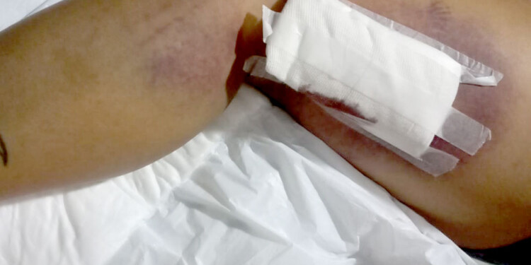 PRUEBAS. Las imágenes evidencian la violencia contra la mujer que tiene como mínimo para 15 días más de recuperación.