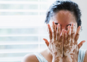 Diputados convirtieron en ley la atención del vitiligo y de las alteraciones en el habla