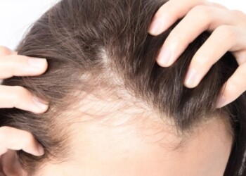 Romper estigmas en el mundo de la alopecia