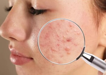 Invitan a la detección gratuita de la hidradenitis supurativa, una dolorosa enfermedad en la piel