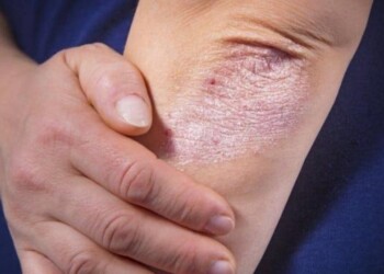 Campaña de detección gratuita de enfermedad psoriásica: hasta el 26 de noviembre hay tiempo de sacar un turno