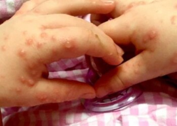 Advierten un aumento de consultas por el virus de la enfermedad mano-boca-pie