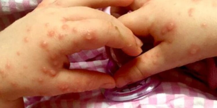 CONTAGIO. El contagio se produce de una persona a otra por el contacto de manos sucias o superficies contaminadas.