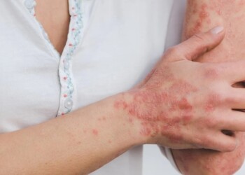 En 2023, Misiones detectó 33 nuevos pacientes con lepra