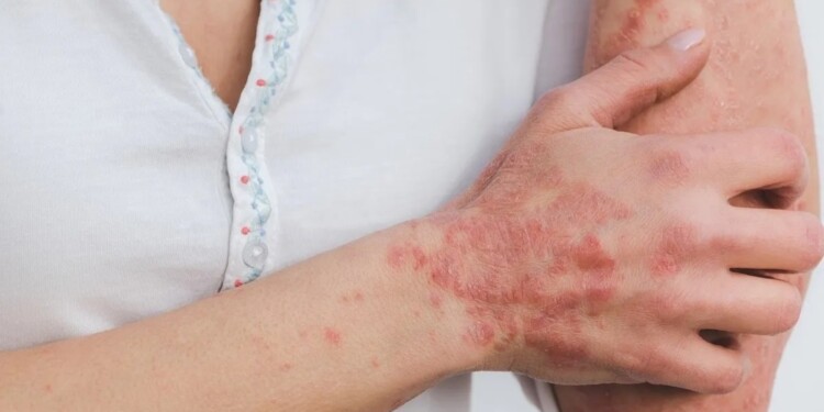 DETECCIÓN PRECOZ. En los consultorios médicos, los profesionales están capacitados para detectar señales de lepra.