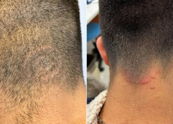 Alertan sobre el aumento de casos del “hongo de las barberías”