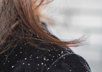 Por qué se produce la caspa y cómo combatirla con remedios caseros