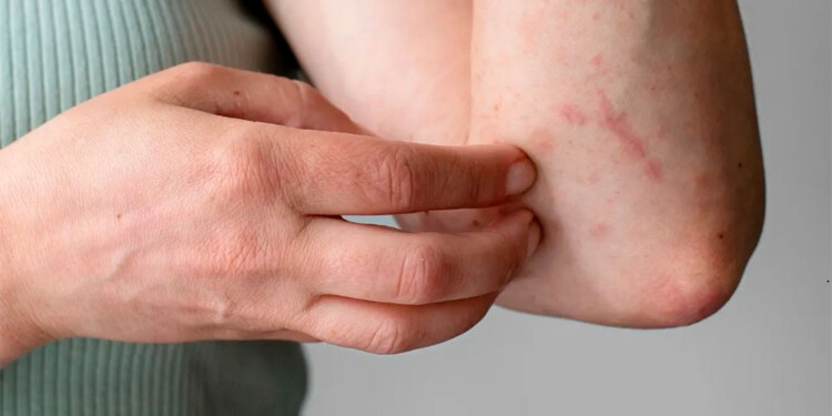 SÍNTOMAS. Durante el curso de la enfermedad, puede aparecer irritación y picazón en áreas del cuerpo.