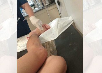 Nuevo ataque de piraña en el balneario El Brete