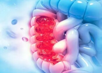 Día Mundial de lucha contra el cáncer de colon: “Aumentó la incidencia en menores de 50 años”