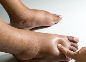 Día del Linfedema: qué es y cómo combatirlo