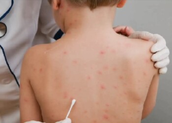 Varicela en Encarnación: “En lo que va del año ya hubo 14 casos en el Departamento de Itapúa”