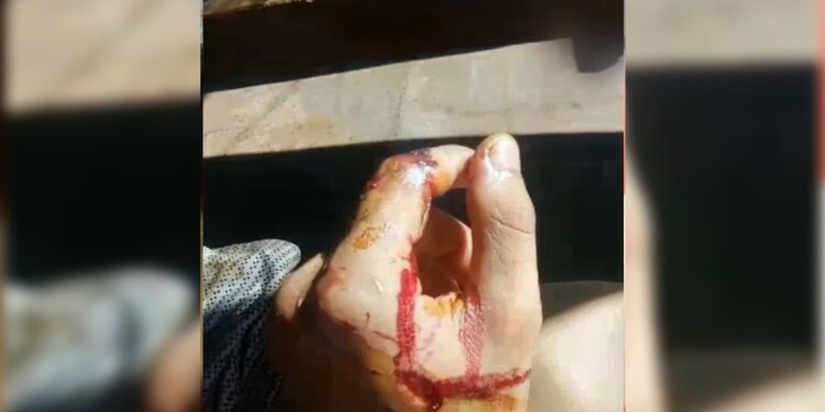 Así quedó la mano del joven tras ser atacado por los perros. Fotos: Norte Misionero