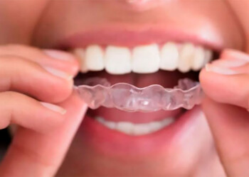 Lo que hay que saber sobre el bruxismo: síntomas y cuándo recurrir al odontólogo