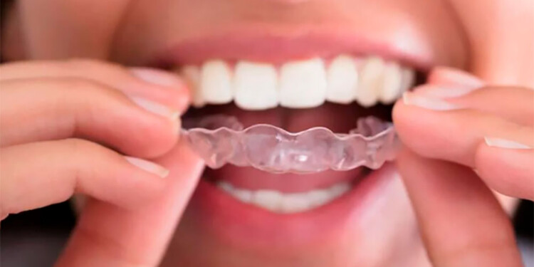 Placa protectora para bruxismo (Imagen temática)