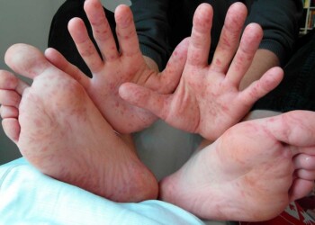 ¿Qué es el virus mano-boca-pie? ¿Hay peligro de infección en las escuelas?