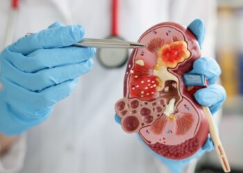 Día Mundial del Cáncer de Riñón: “De cada 10 pacientes que son diagnosticados, 9 son de manera accidental”