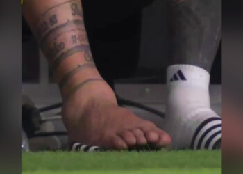 Copa América: la impactante imagen del tobillo de Messi