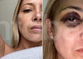 Denuncia contra Alberto Fernández: difundieron las fotos de Fabiola Yáñez golpeada