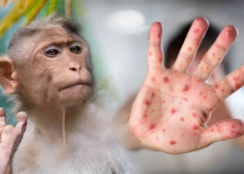 Habría un segundo caso confirmado de viruela símica en Rosario