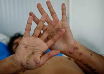 Suecia confirmó el primer caso de la nueva cepa de la viruela del mono fuera de África