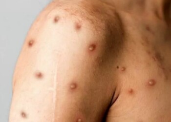 La OMS declara emergencia sanitaria mundial por la viruela del mono