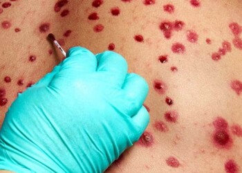 Confirmaron el primer caso de viruela del mono en Corrientes