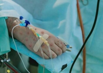 ¿América Latina está preparada para la viruela del mono?