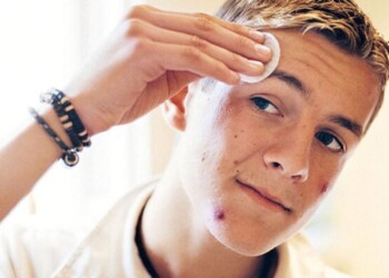 Cinco tratamientos naturales contra el acné