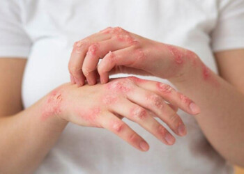 Lepra: “Cuando el paciente toma la primera pastilla, ya no contagia más”