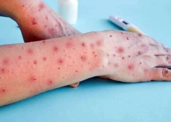 Alerta en Encarnación: activan protocolo por un caso sospechoso de viruela del mono