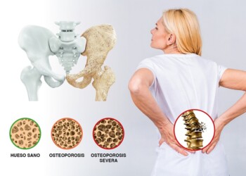 Osteoporosis  y suplementos
