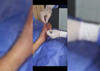 ¿Larvas de mosca para evitar amputación en paciente con pie diabético?