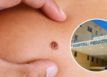 Campaña de detección de lunares y cáncer de piel en niños: ¿qué es el signo del Patito Feo?