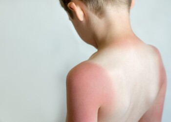 El daño solar en la infancia “eleva muchísimo la posibilidad de melanoma”