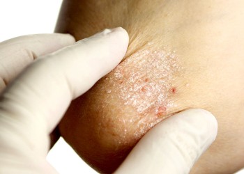 Psoriasis, enfermedad con la cual viven 800 mil personas en Argentina