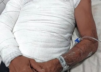 Discutieron por un sachet de mayonesa y uno terminó con el cuerpo quemado