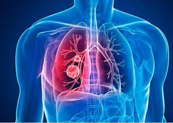 Si padecés esta enfermedad, tenés un 50% de probabilidades de que no te la detecten