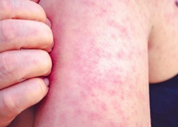 “El brote de sarampión es porque no nos vacunamos”