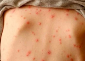 Misiones: proponen cambios en las aulas ante la circulación de sarampión en Buenos Aires