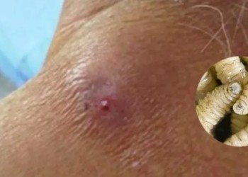 Detectan el primer caso humano de miasis por gusano barrenador en México